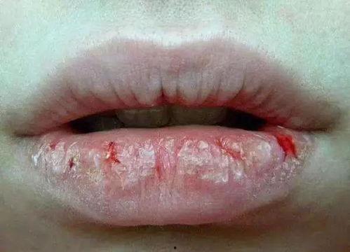 吃白色瓜嘴唇疼,白色瓜类美味解析，揭秘嘴唇疼痛之谜